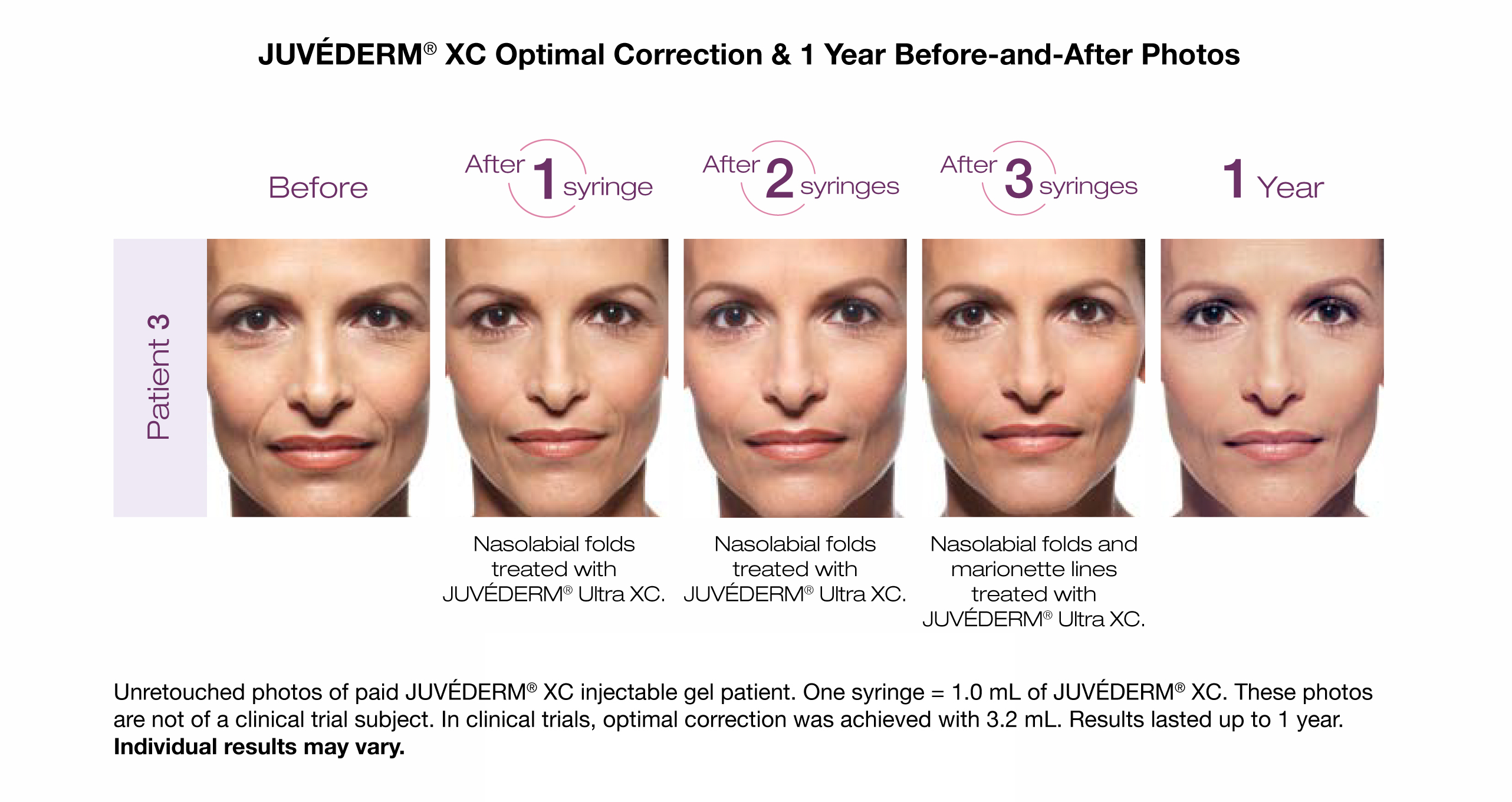 Juvederm XC in Utah Thompson Facial Plastics