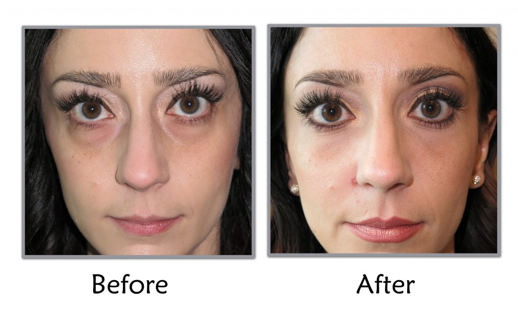 facial liposuction gels nepali sexy teen models