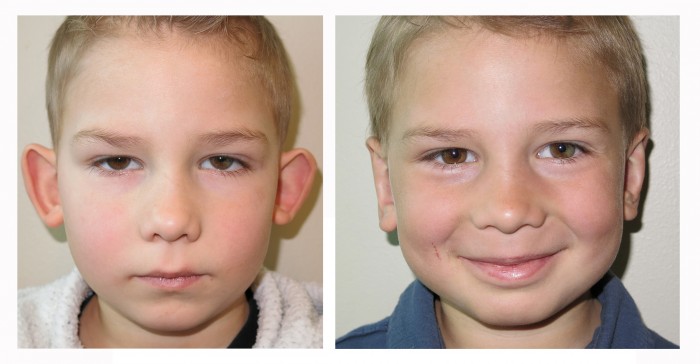 Can not non surgical otoplasty for adults shall Are mistaken. non surgical otoplasty for adults suggest