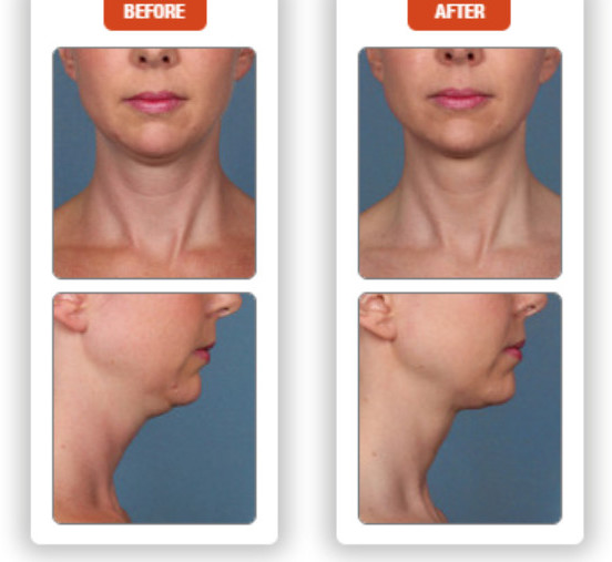 What Is Kybella and How Does It Work? Utah Facial Plastics