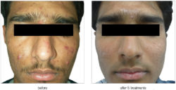 Laser facial procedures slc utah Www lick my ass