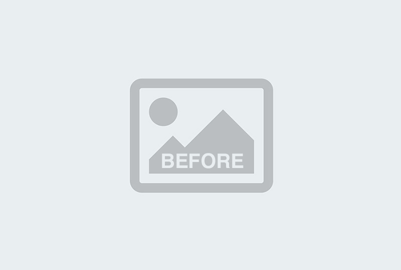 Before Image: Facelift | Eyelid Surgery | Jowl Implant | CO2 Laser – 823 - 