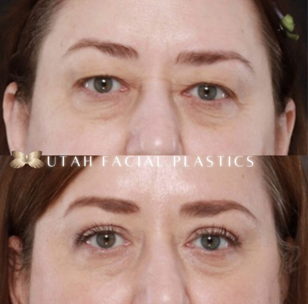 blefaroplastia