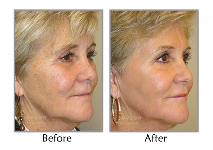 Fractional CO2 Laser Resurfacing | Utah Plastic Surgeon