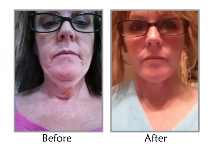 Facelift Patient Before & After Selfie