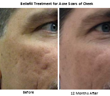 The Latest Acne Scar Treatment - Bellafill