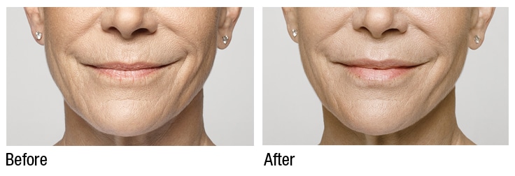 Restylane before and after
