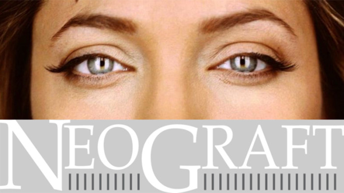 eyebrows with neograft
