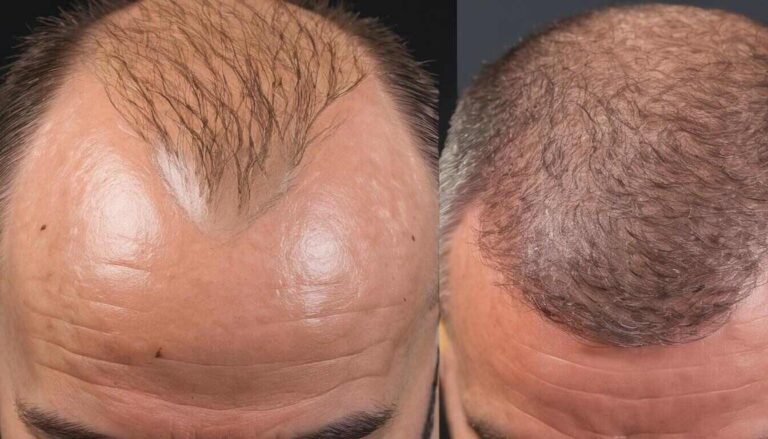seamless fue vs other methods