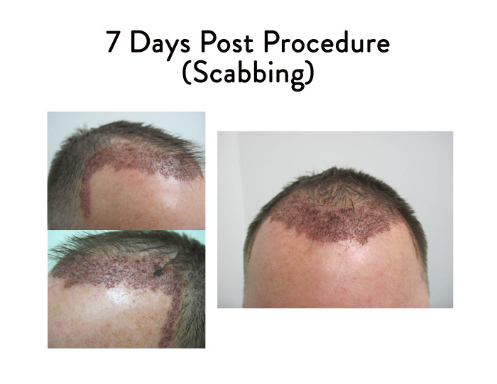 7 Days Post Hair Restoration Surgery - Scabbing