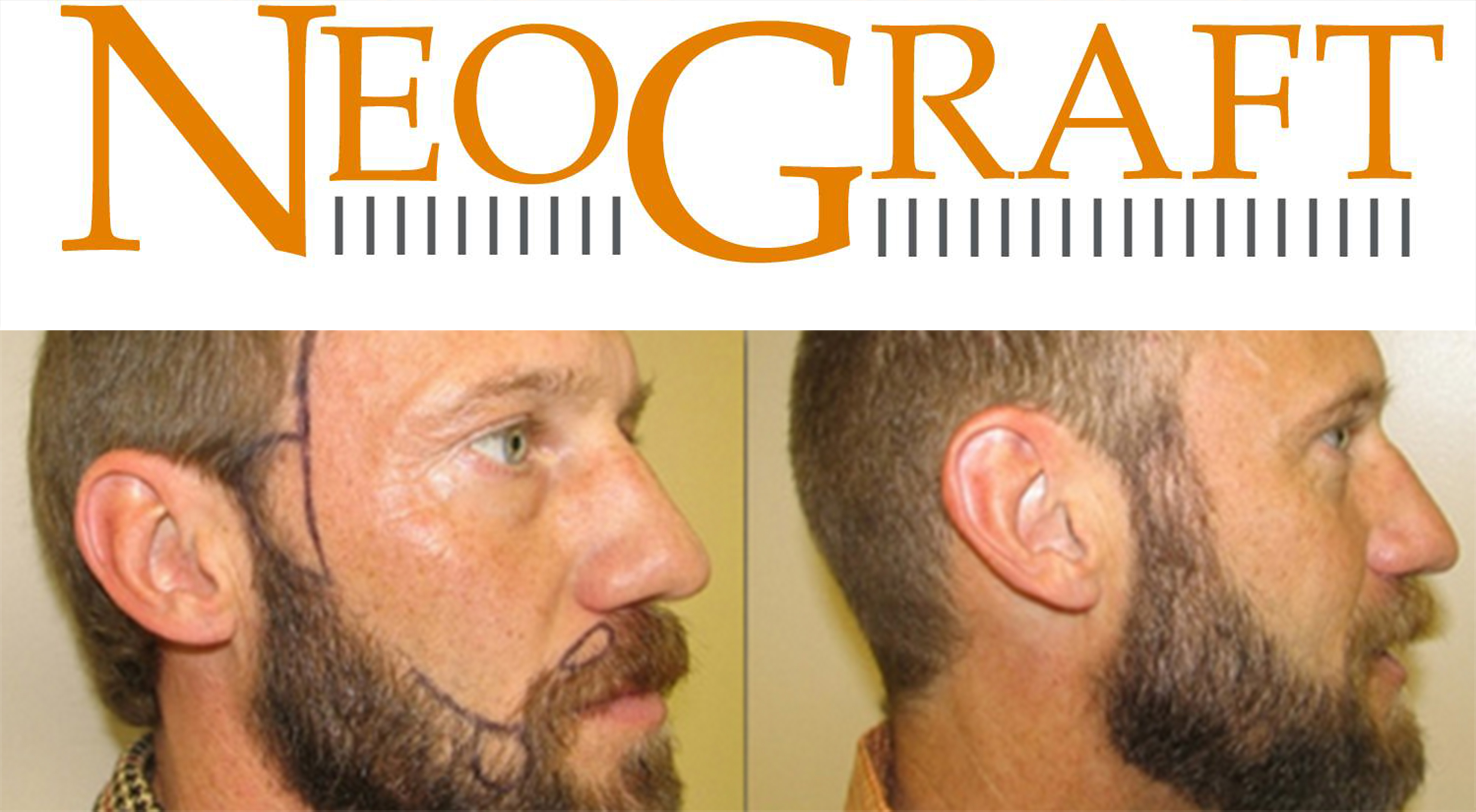 NeoGraft Beard Transplant Utah Facial Plastics