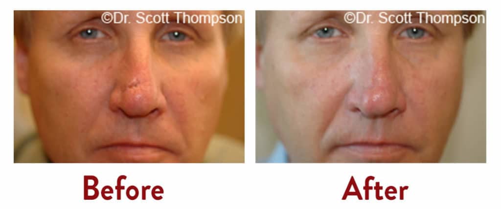 scar revision utah plastic surgery 2