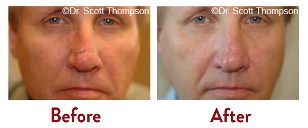 Scar Revision Treatment Salt Lake City Ut Utah Facial Plastics