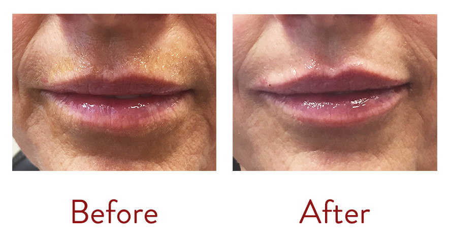 Lip Rejuvenation with Juvederm Ultra XC