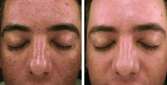 patient's face before and after skin pen treatment, freckles less visible after treatment