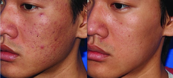 patient's face before and after skin pen treatment, acne gone after treatment