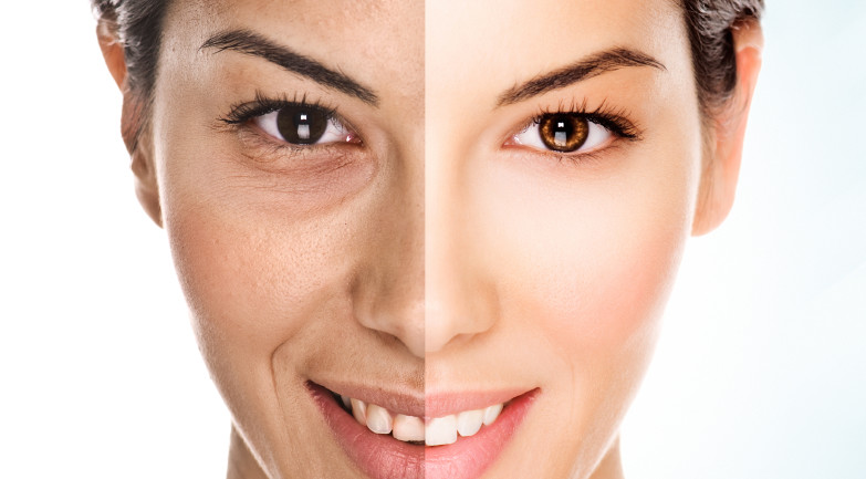 Fat Grafting vs. Fillers for Facial Volume