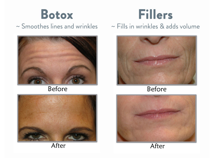 Best facial wrinkle treatments pics 606