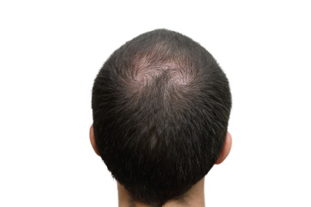 42705385 - closeup background of bald head