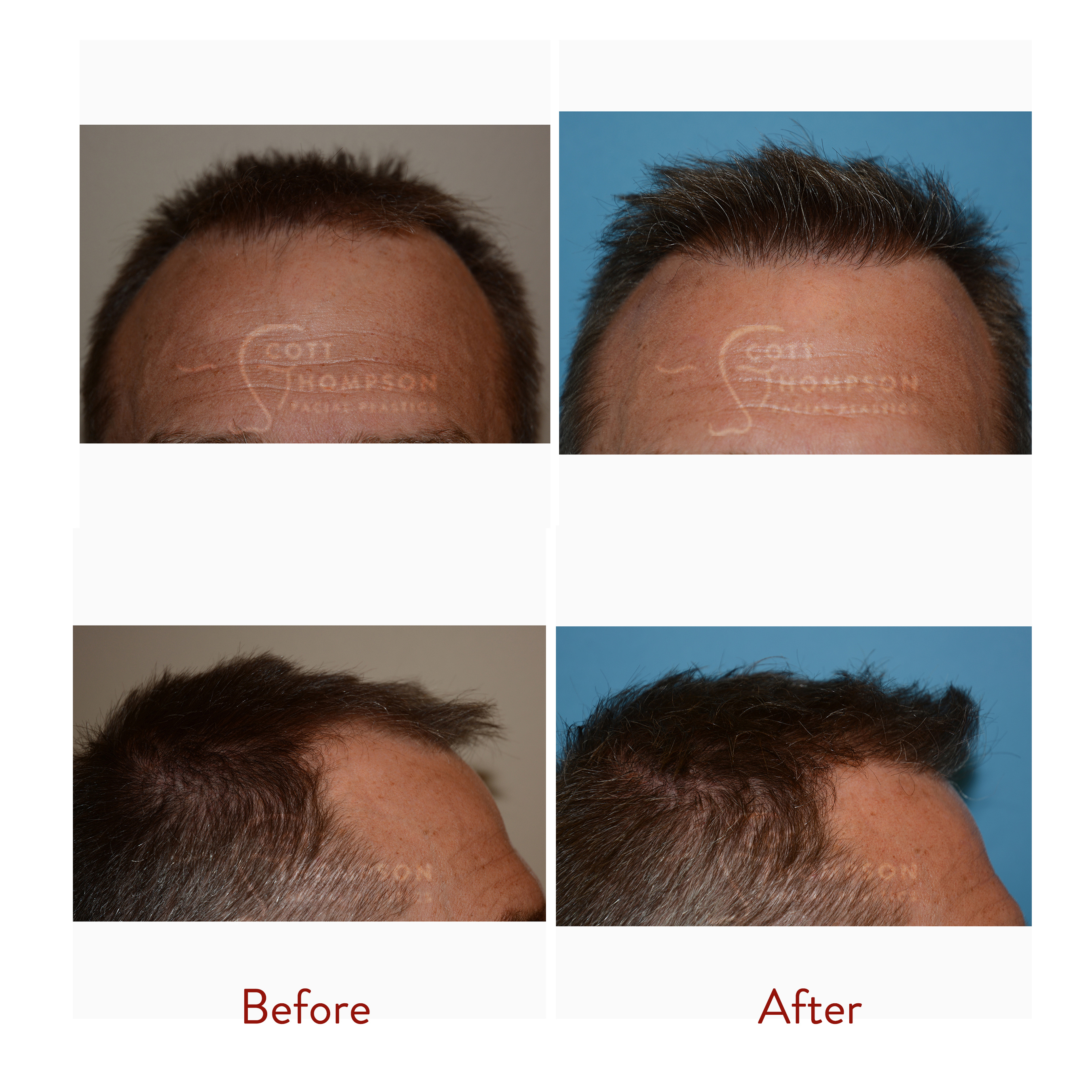 NeoGraft Hair Transplant Surgery at Utah Hair MD