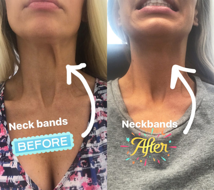 Botox for Neck Bands - Utah Facial Plastics