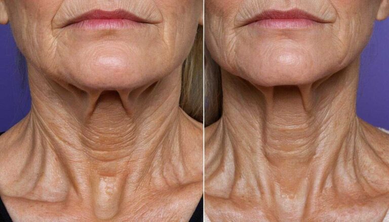 Neck bands before Botox