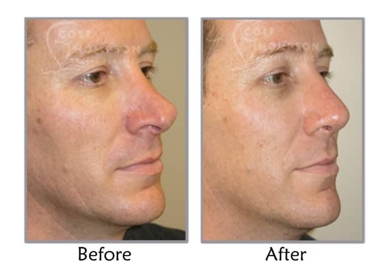 Rhinoplasty Salt Lake City Nose Job Draper Layton, UT