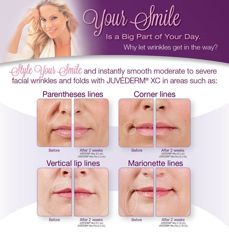 juvederm-card