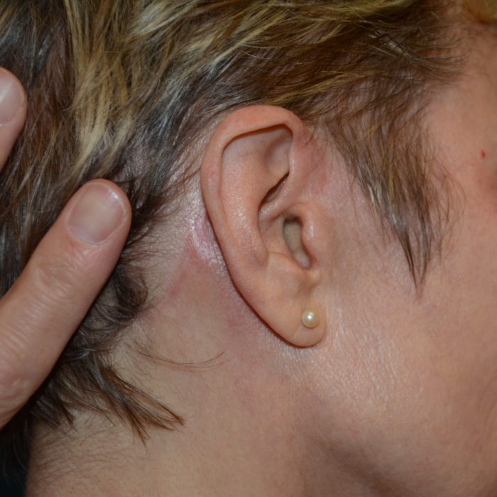 Think, that plastic surgery facial scars healthy! Opinion you plastic surgery facial scars something is