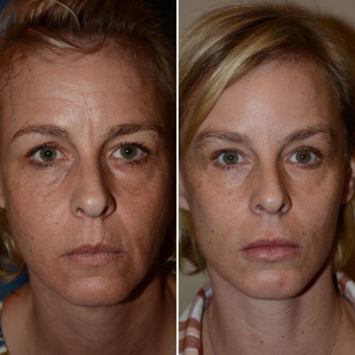 What is the best age for a facelift? Salt Lake City, Utah
