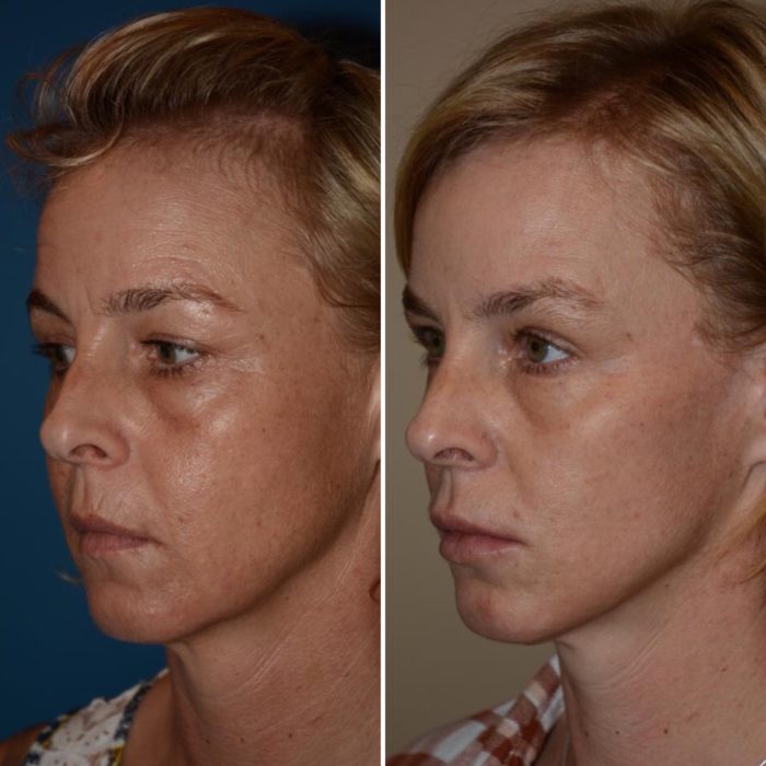 What is the best age for a facelift? Salt Lake City, Utah
