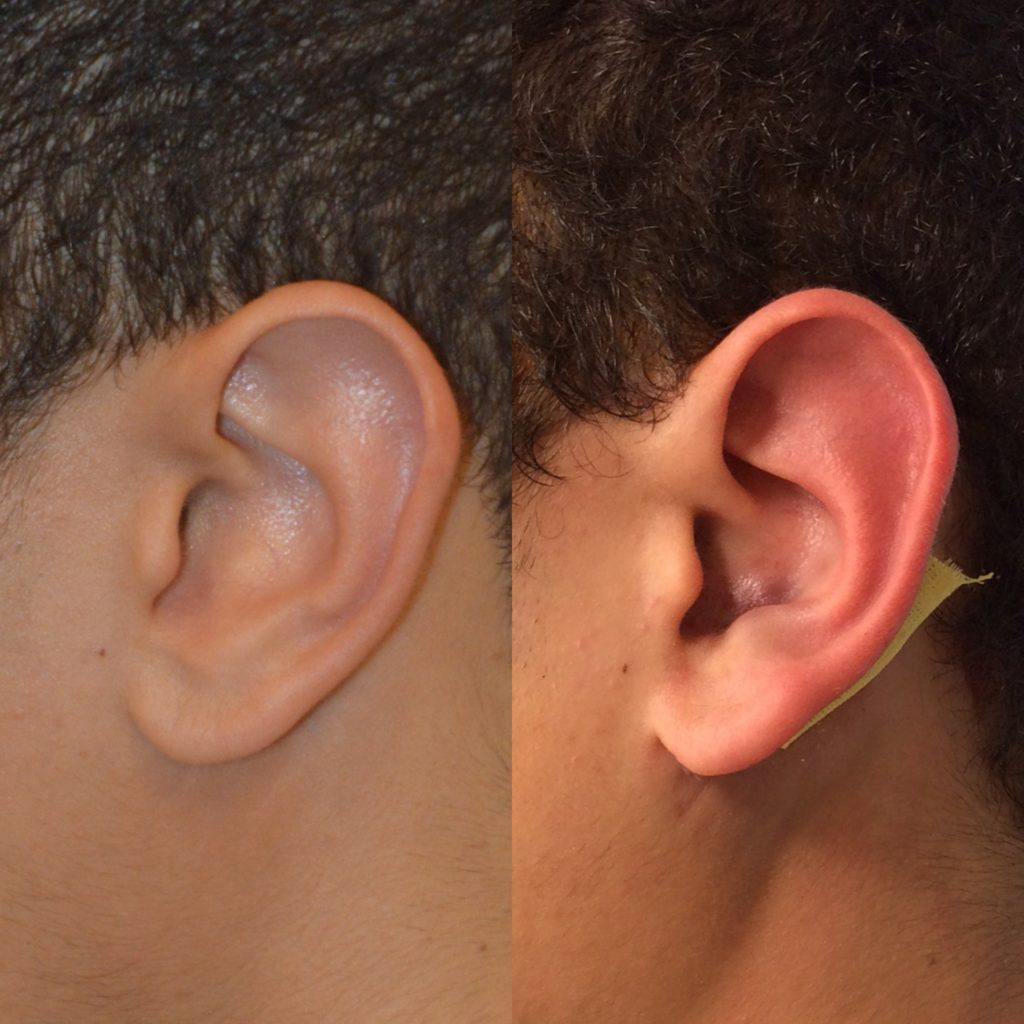 Ear Reconstruction Patient Review Utah Facial Plastics