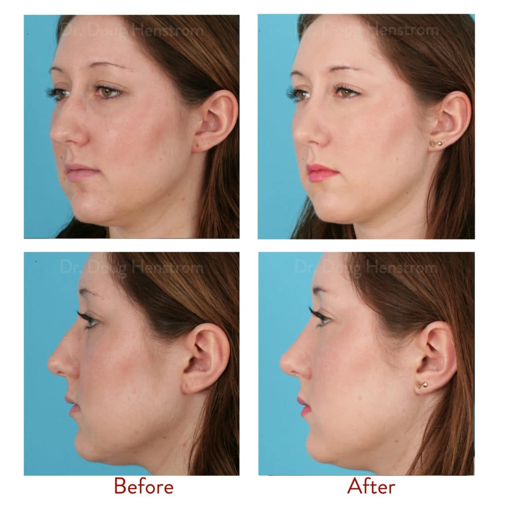 How Long Does Your Nose Continue To Change After Rhinoplasty?