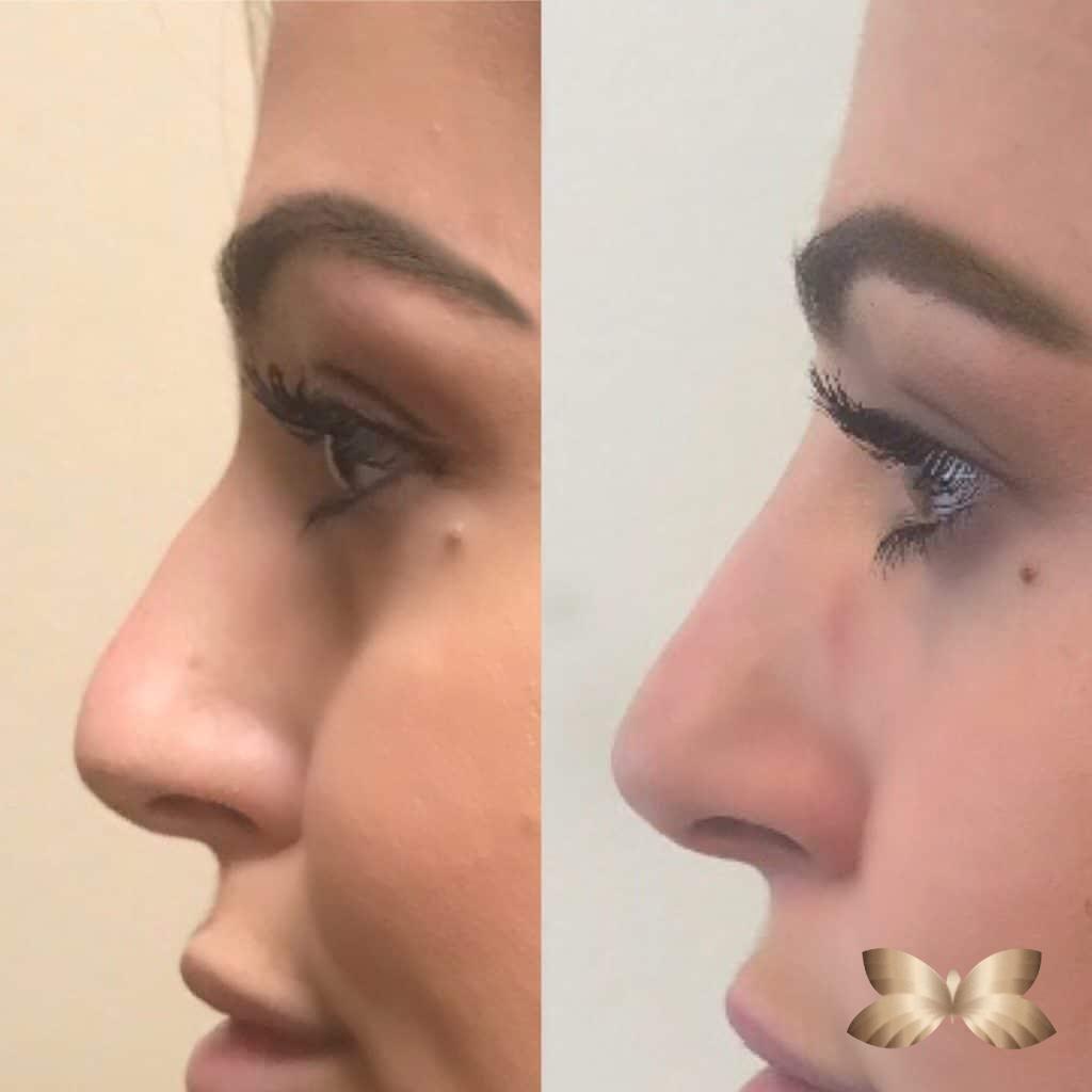 non-surgical nosejob