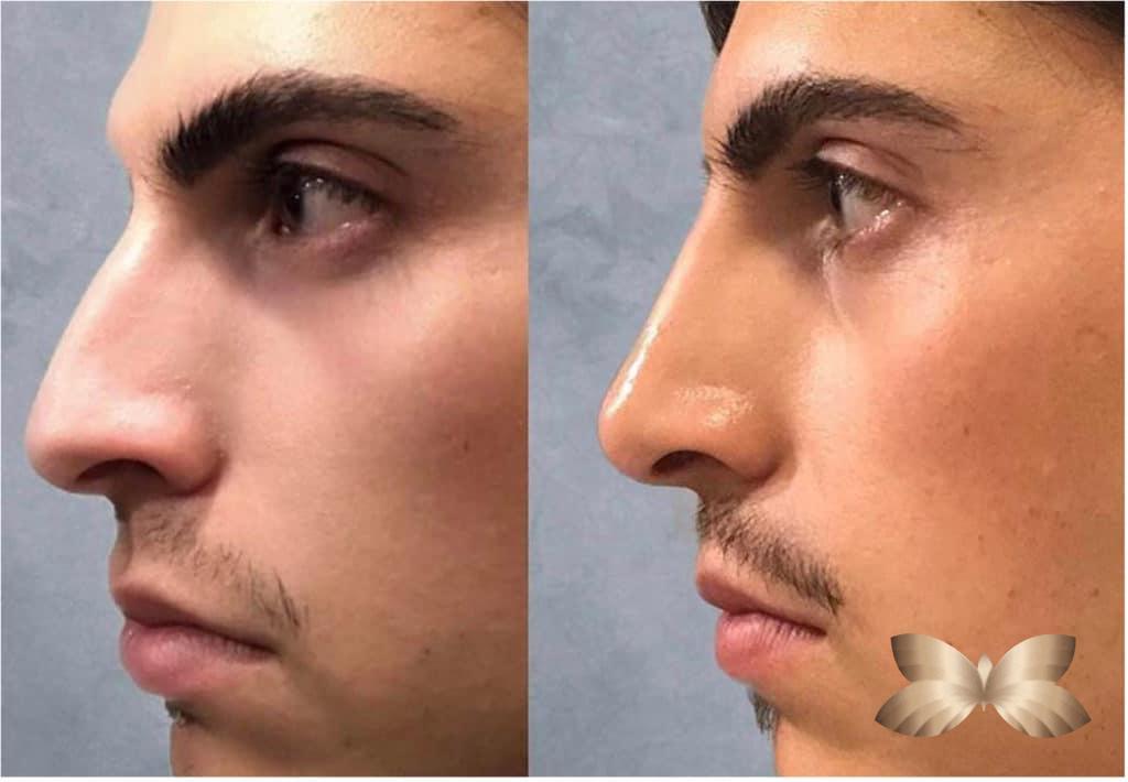 How long do nose fillers last? - Utah Facial Plastics