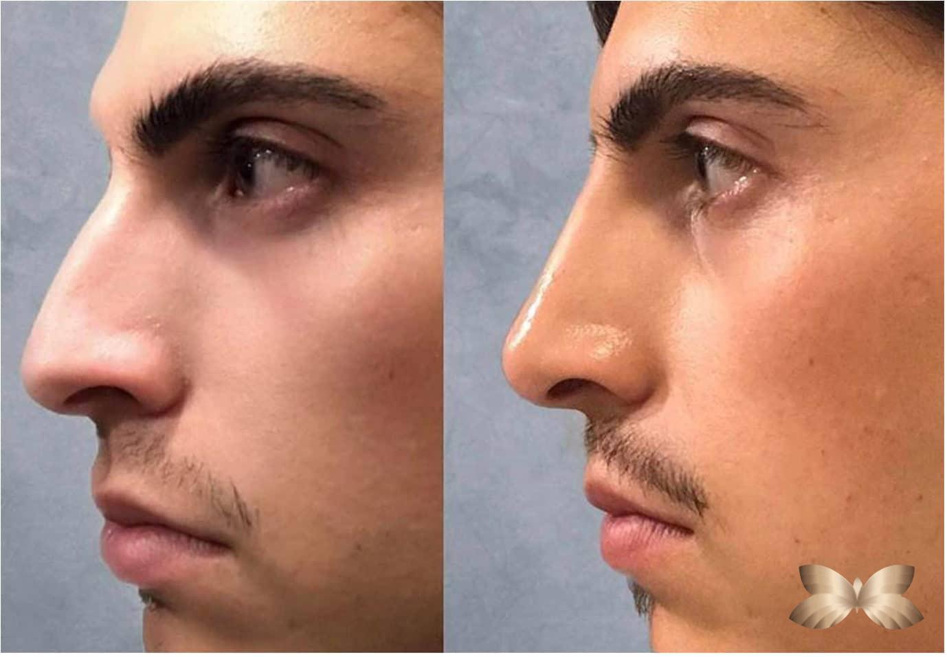 Pictures nose jobs without surgery
