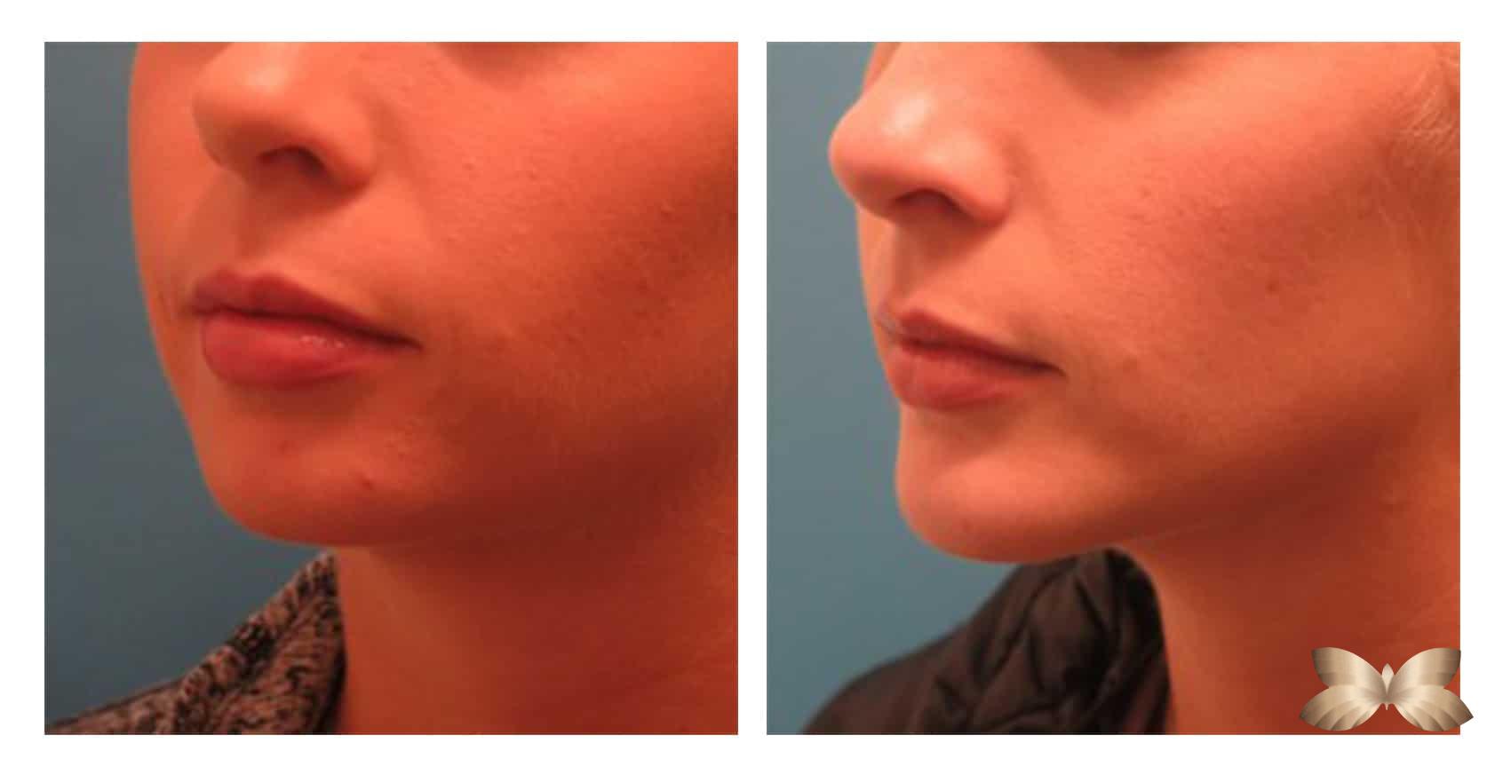 Chin Augmentation by Dr. Henstrom