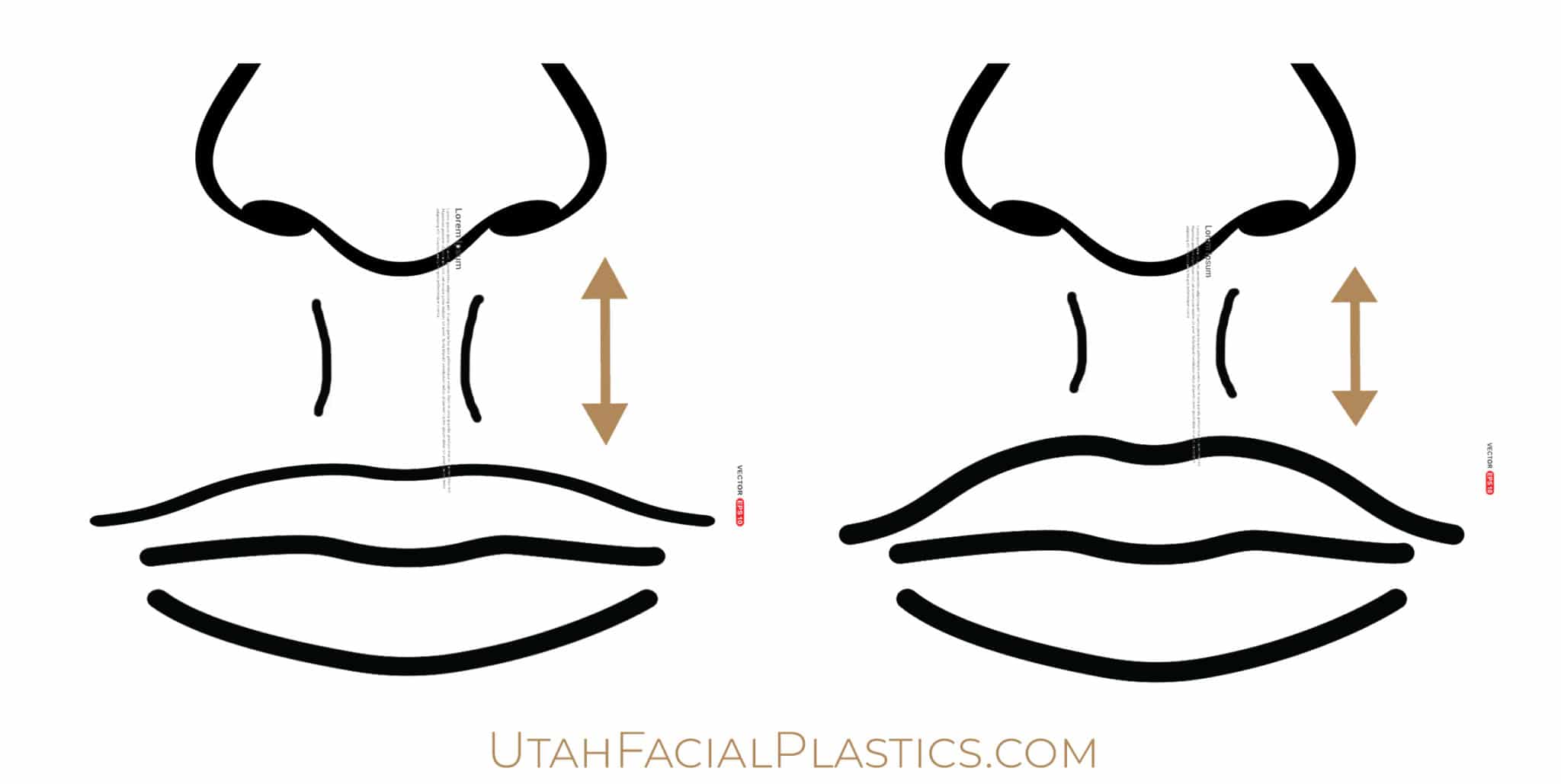 Lip Lifts Salt Lake City, UT Utah Facial Plastics