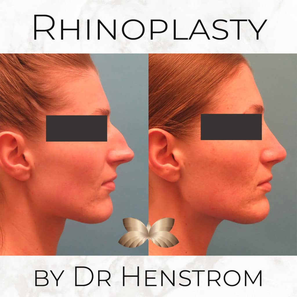 Rhinoplasty Review For Top Utah Plastic Surgeon Slc Utah