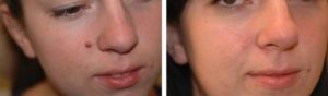 Mole Removal