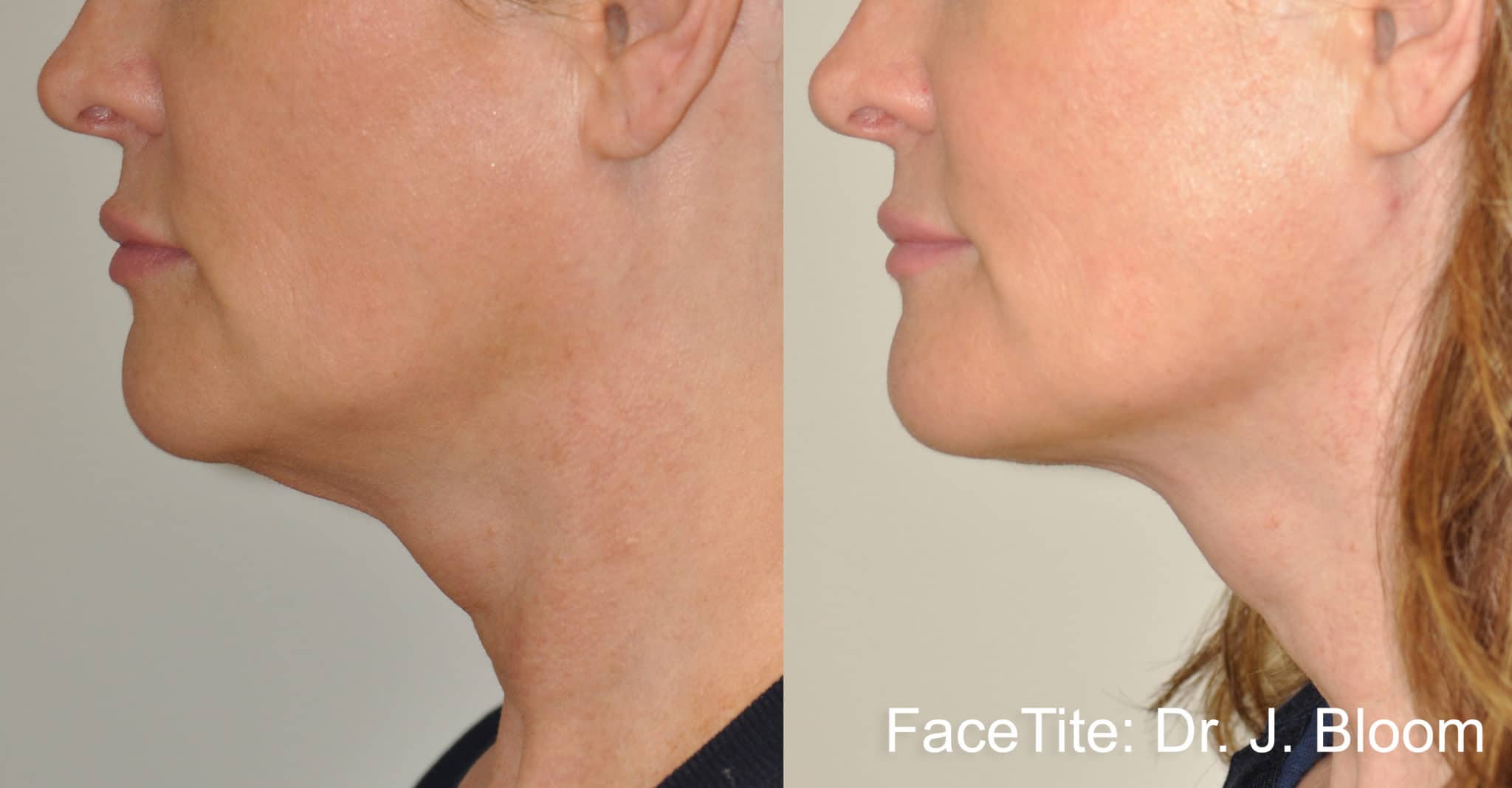 FaceTite - Utah Facial Plastics
