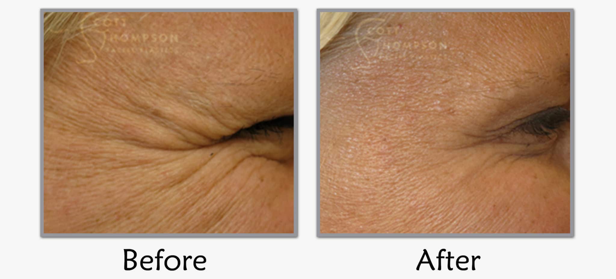 botox injections before and after utah facial plastics