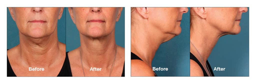 se puede inyectar l carnitina en la papada Kybella Salt Lake City, UT