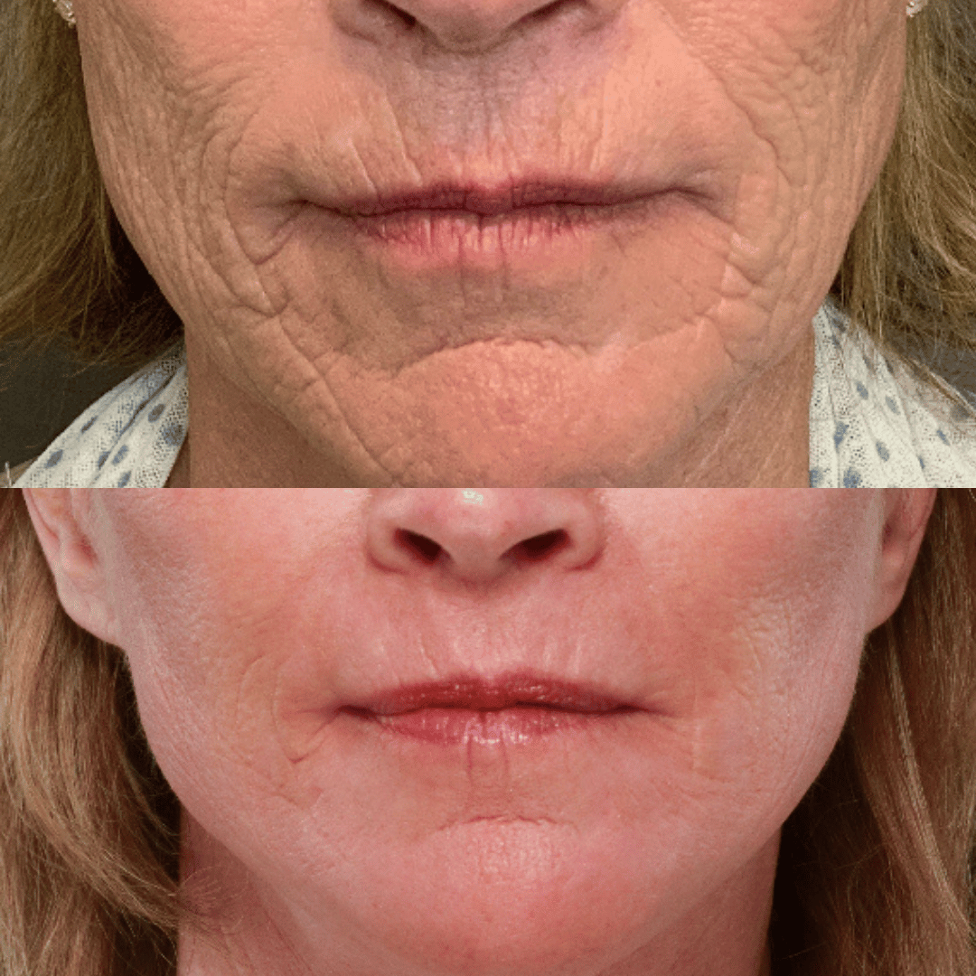 dermabrasion dermabrasion