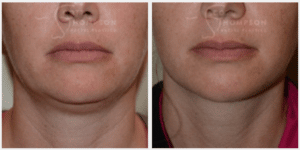 Before and after submental liposuction