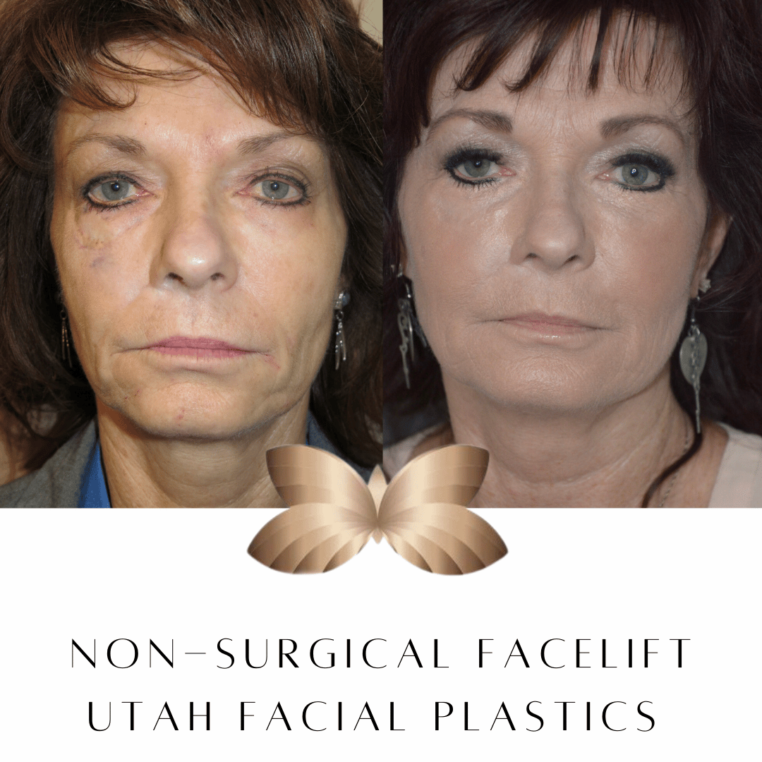 The NonSurgical Facelift at Utah Facial Plastics Utah Facial Plastics