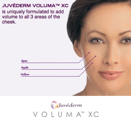 JuvedermVolumaXC 1 JuvedermVolumaXC 1