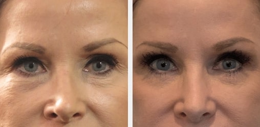 fat grafting fat transfer utah facial plastics 1 fat grafting fat transfer utah facial plastics 1