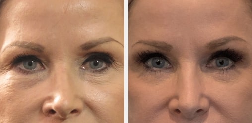 fat grafting fat transfer utah facial plastics 1