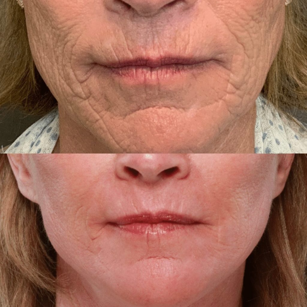 woman’s mouth before and after dermabrasion treatment, many fewer wrinkles around lips and cheeks after procedure